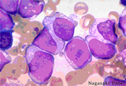 leucemia_acuta.jpg